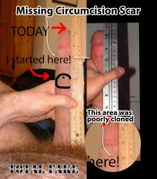 Missing Circumcision Scar.jpg