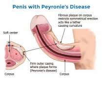 penis-with-peyronies-disease_13.jpg